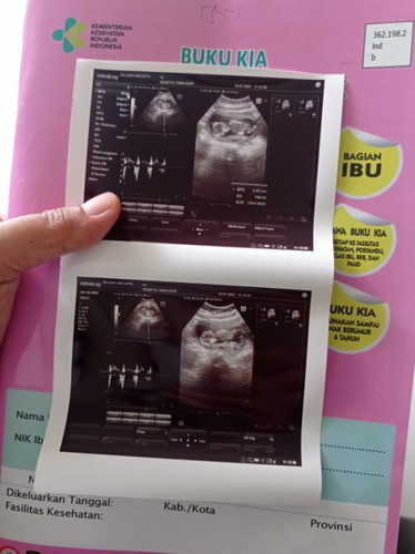 Bun, sy lagi hamil 14 mgu. Tp djjnya kmrin pas usg, udh kedengaran, tp kadang g kedeteksi, nrmal ga?
