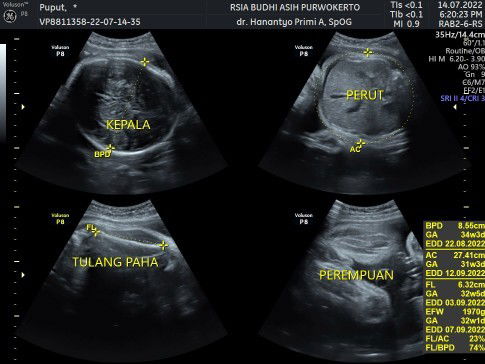 Cara nambahin bbj janin