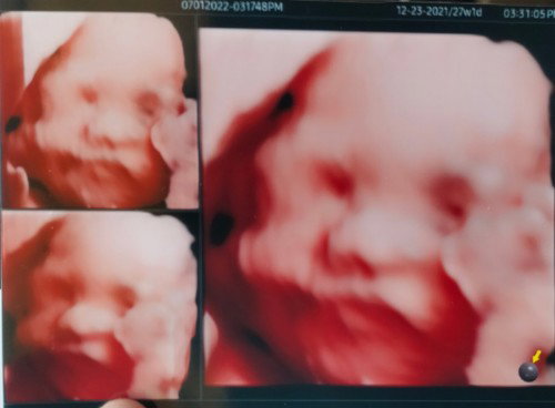 4D ultrasound