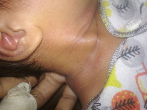 Bayiku usia seminggu bun ada yg pernah ky gni gak?.. Ini kenapa y obat ny apa?..
Biyang keringat buk