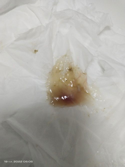 เจอแบบนี้อันตรายไหมค่ะแม่ๆบ้านไหนรู้ขอคำแนะนำหน่อยค่ะ  33วิค 2วัน