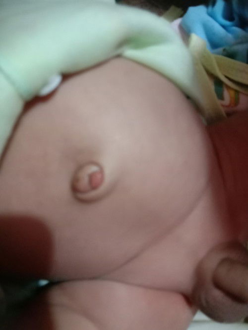 Puser bayi ada yg nonjol