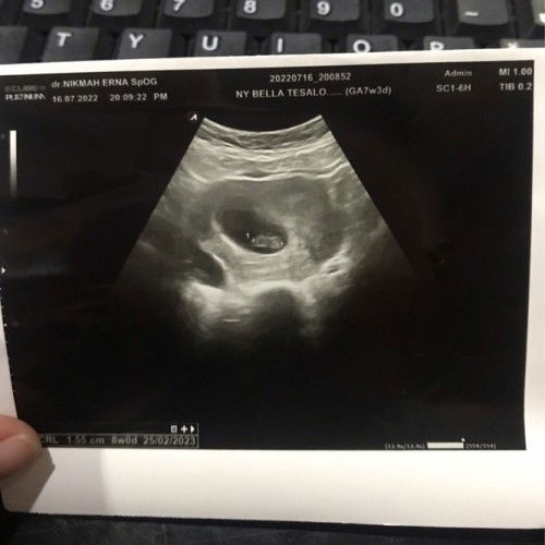 Sharing Cerita Kehamilan