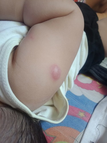 natural lang po ba na lumaki ang injection ni baby yung baby ko po kase lumaki po . worried lang po