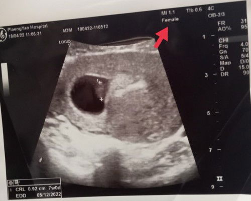 ขอคำแนะนำหน่อยจ้า ตรงลูกศรสีแดงใช่เพศของลูกในท้องไหมคะ