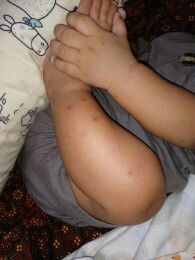 Menghilangkan bekas Gigitan Nyamuk