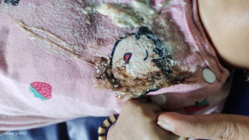 Bayi muntah warna coklat