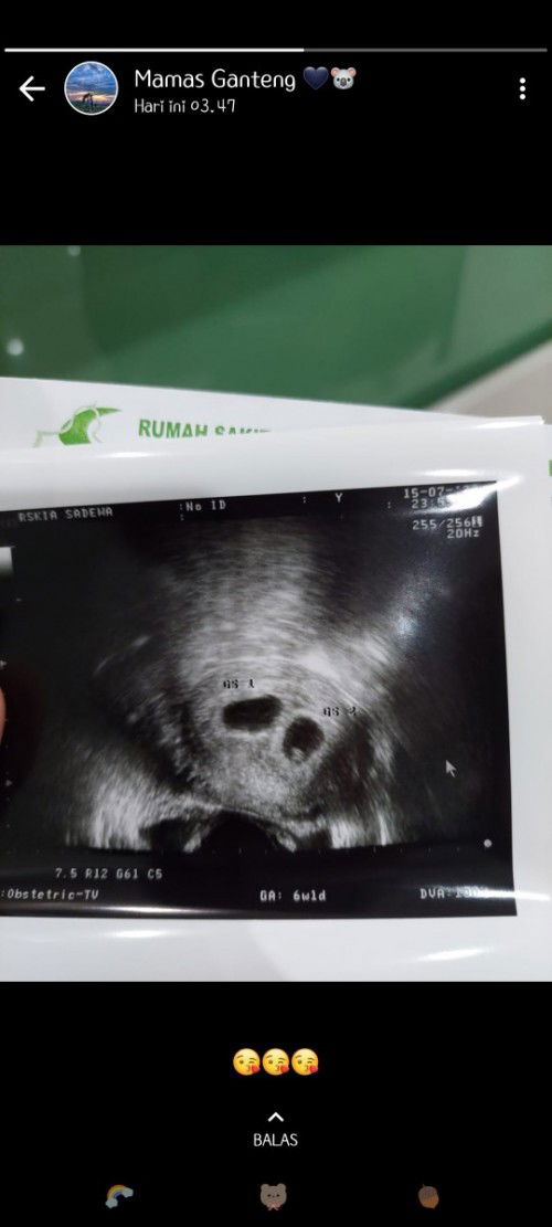 Hamil kembar 7w