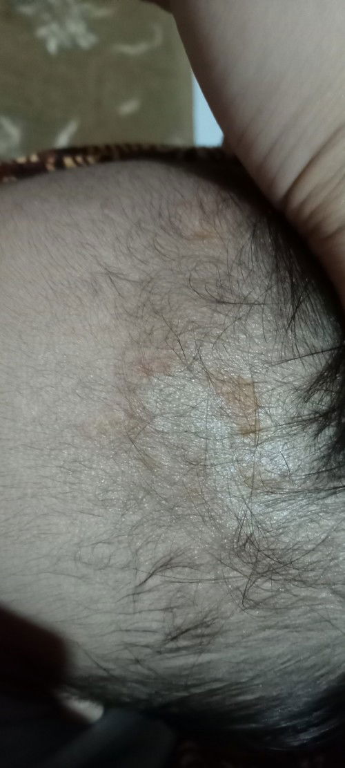 Merah di kulit kepala