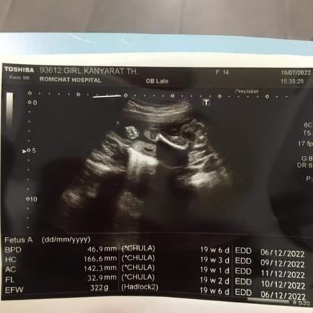 สอบถามแม่ๆค่ะ แบบนี้ปกติมั้ยคะ ตอนแม่ๆอายุครรภ์เท่ากันน้องหนักกี่กรัมคะ