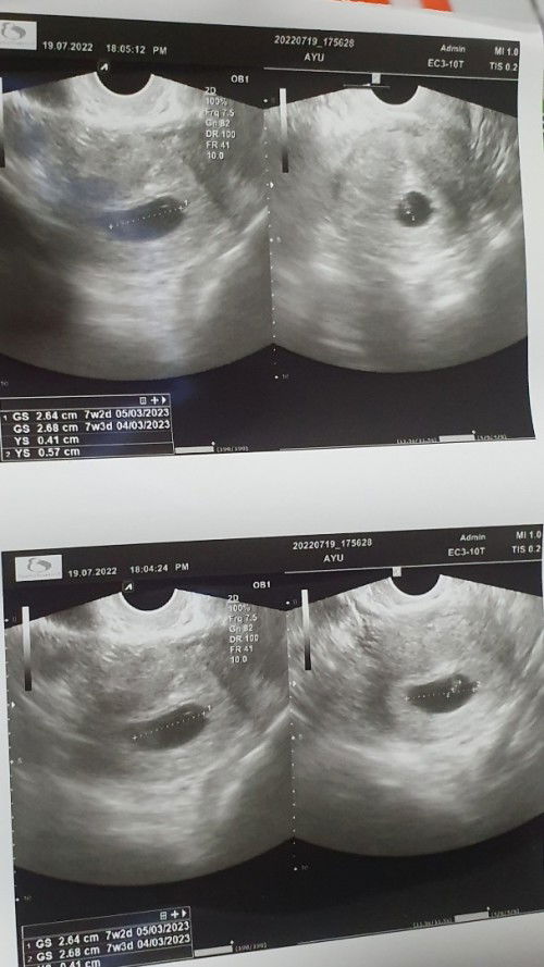 Usia 7w2d, masih kantung dan janin samar. Usg TRAN V