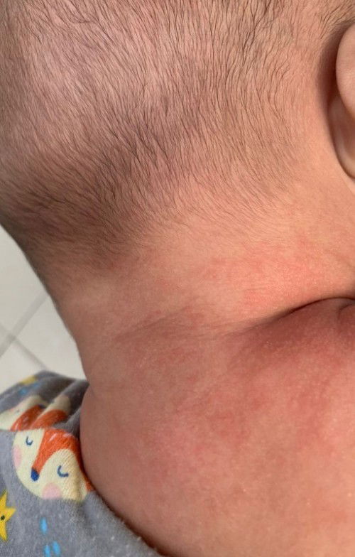 Merah merah di leher