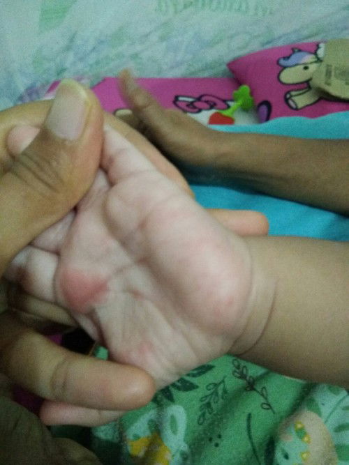Bun ada tau tanda" alergi?  Ini alergi atau scabies ya bun?