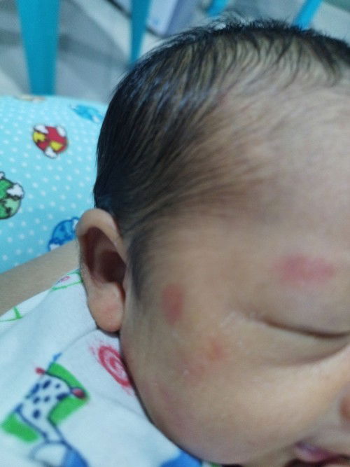 Merah2 pada kulit bayi