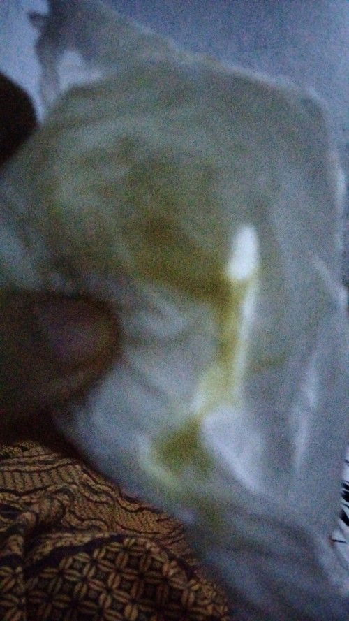 Keputihan setelah melahirkan