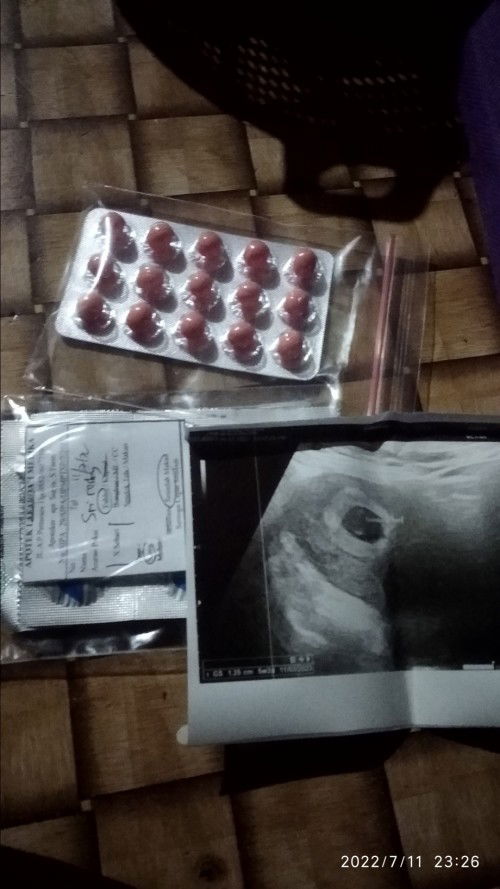 Kantung janin ada tapi masi kosong