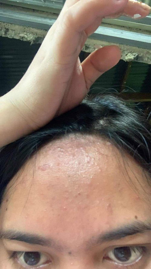 Pimples while pregnant