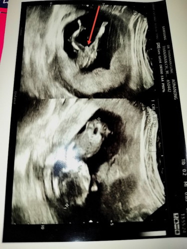 เมื่อใบซาวด์เห็นคล้ายจู๋แต่ผลNIPTบอกไม่เจอค่าy