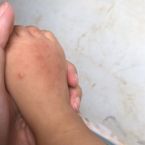 Chân bé bị nổi hột
