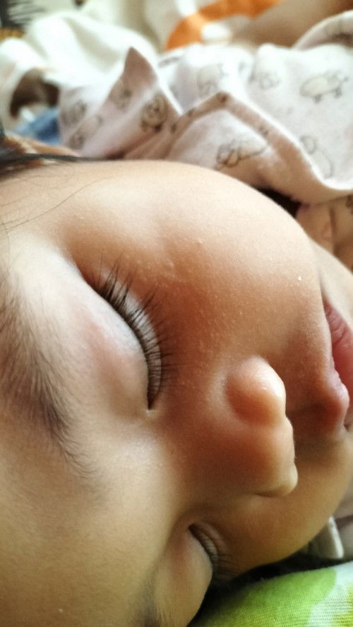 ผดเล็กละเอียดขึ้นที่ใต้ตา