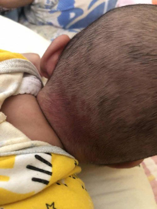 Merah dibelakang kepala anak