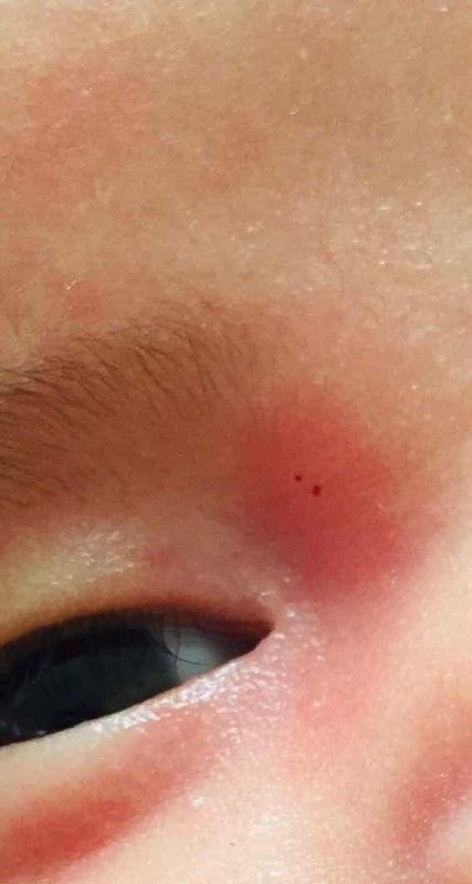 Something malapit sa mata