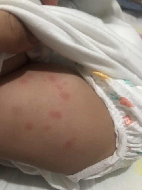 Bites or rashes?