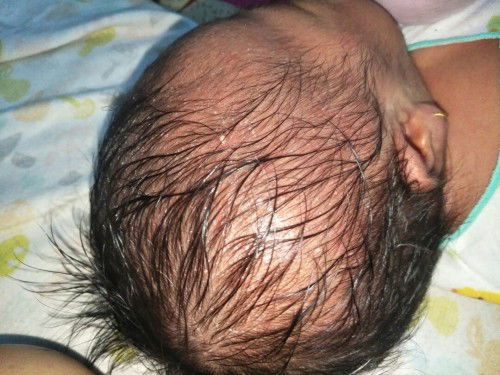 Bintik di kepala bayi baru lahir