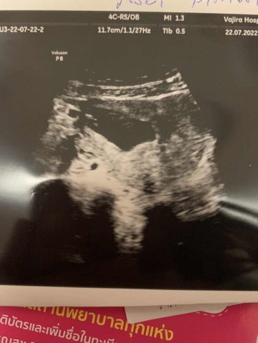 ช็อคมากท้องลม12week