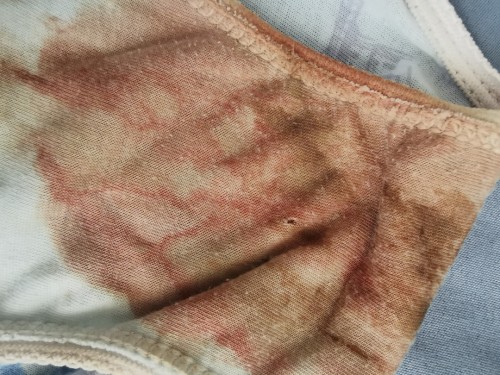 is this sign of miscarriage?