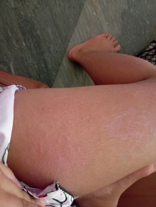 แพ้อะไรก็ไม่รู้ ท้อง33วิค