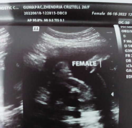 Hi mga mommy ask lang of ever 100% accurate ng girl si baby?? 23 weeks ako nung nag paultrasound.