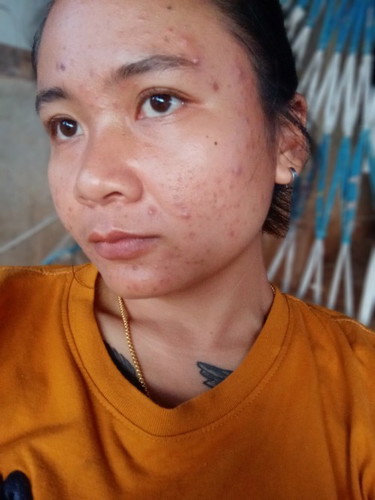 เป็นสิวตอนท้อง