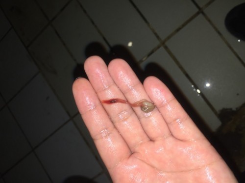 May lumabas po na parang laman. Ano po kaya ito? Nakunan po ba ako?
