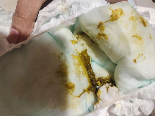 Normal po ba ganyang kulay ng dumi ng baby ko 8months po siya, 4x a day siya tumae at may lagnat