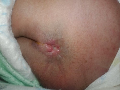 Ass. 
Selamatpg bunda saya mau tanya bayi saya dari lahir ada lubang kecil diatas pantat baby saya.