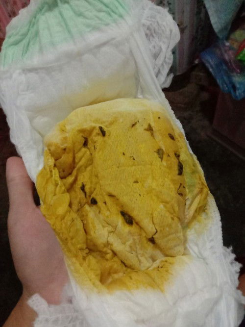 Lo lắng khi thấy bé ị như thế này