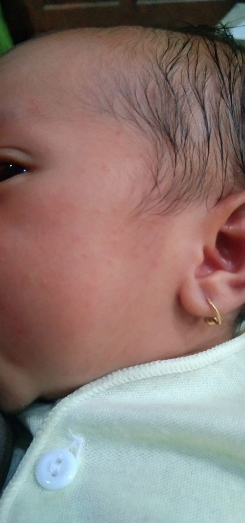 Bintik bintik di pipi