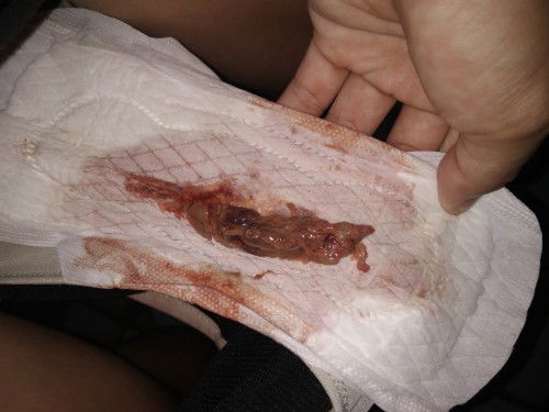 ก้อนอะไรคะ ออกมาพร้อมกับน้ำคาวปลา #ขออภัยรูปภาพไม่น่าดูด้วยนะคะ