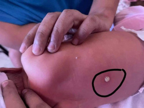 Blister sa likod ni LO