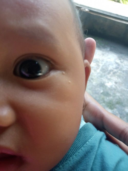 Milia bayi umur 5 bulan