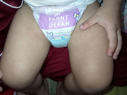 BINTIK MERAH TIBA-TIBA