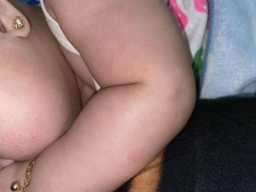 Eksim baby umur 4 bulan