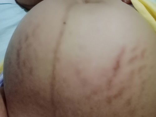 Strecmark usia kandungan 35-36 weeks