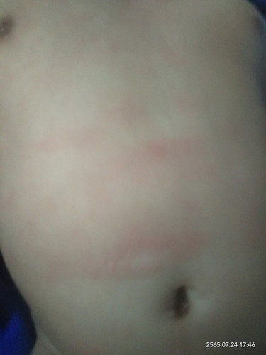 บริเวณท้องน้องมีแบบนี้คืออะไรคะแม่ๆ