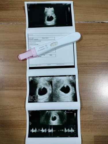 6w3D คุณแม่มีปีกมดลูกข้างเดียวคะ รอน้องมาหลายปี เคยหมดหวังจนคิดว่าชาตินี้คงไม่มีกับเค้าหรอก