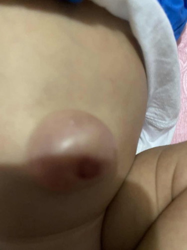 Pusat baby timbul . 1bulan 25 hari