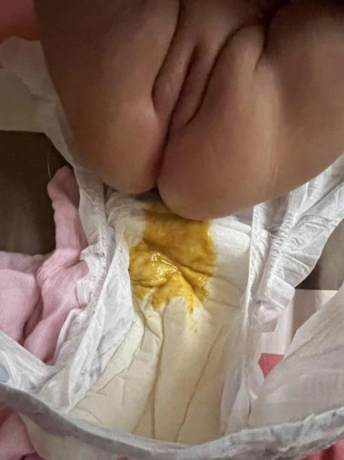 Watery na pupu ni baby