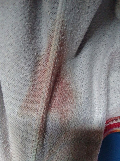 Normal lang po ba mag bleeding 18weeks preggy po??

Bawas pa po ba tawag Jan?