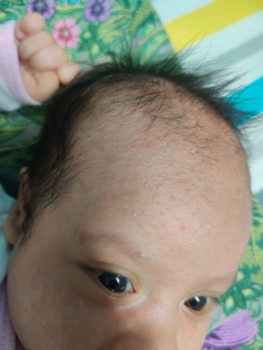 Ruam di dahi bayi